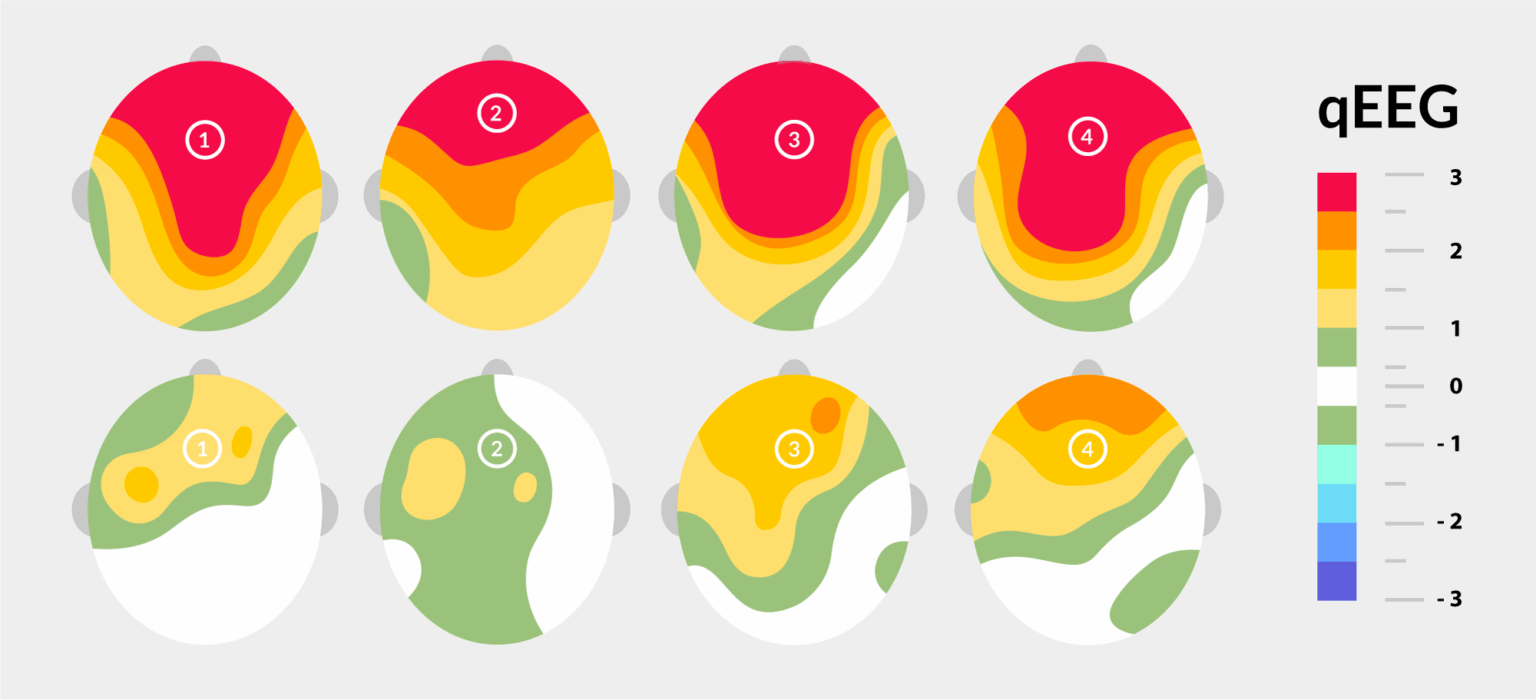 Desarrollo de un mapa de actividad cerebral a través del método qEEG